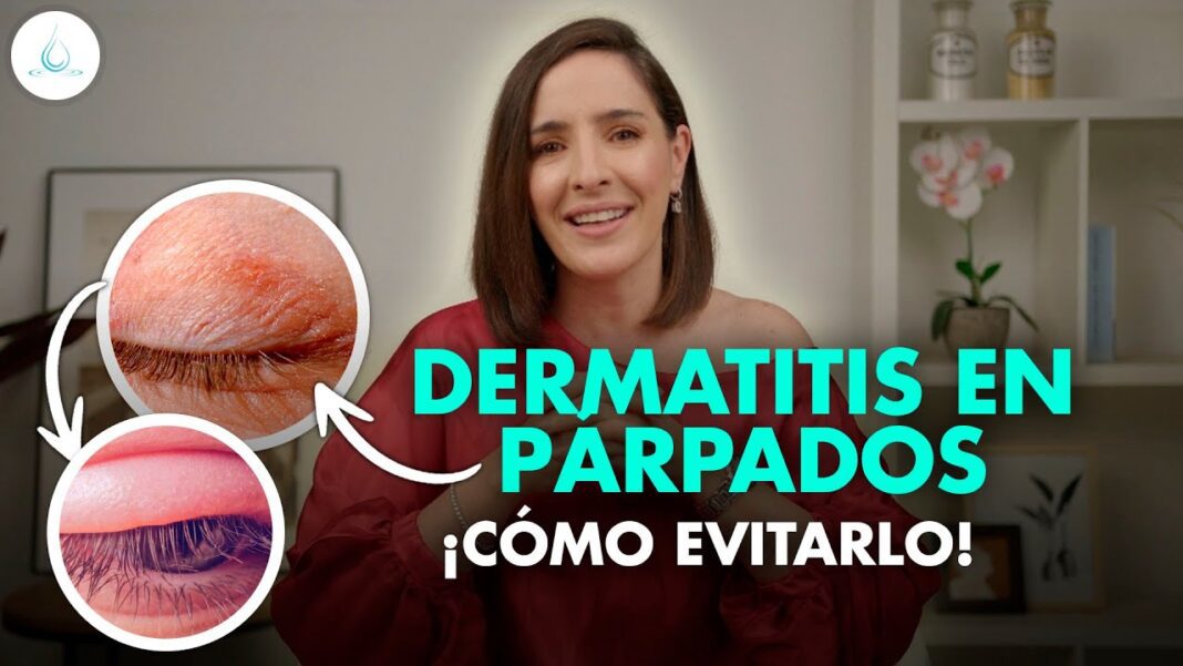 dermatitis-en-parpados-remedios-caseros