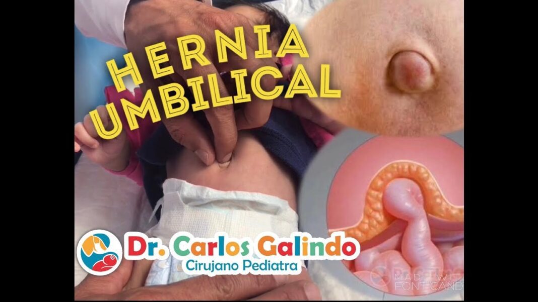 hernia-umbilical-en-bebes-remedios-caseros