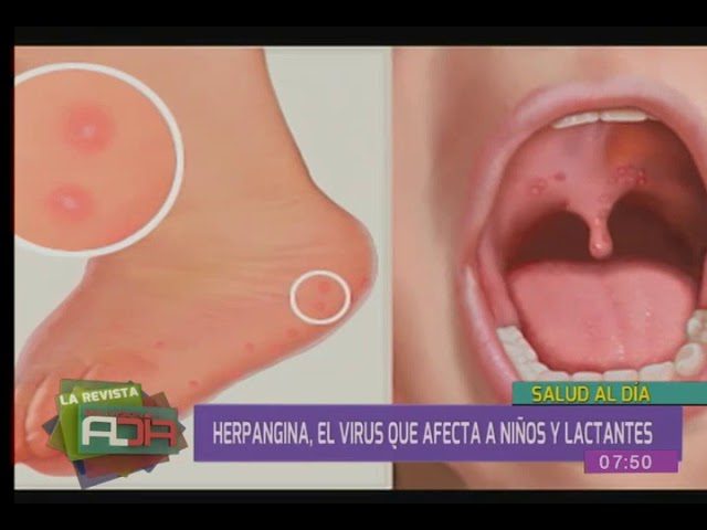 herpangina-en-ninos-remedios-caseros