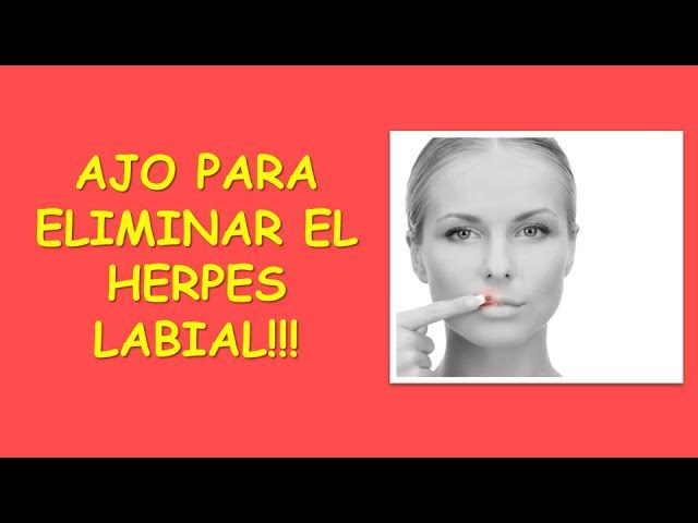 herpes-labial-remedios-caseros-ajo
