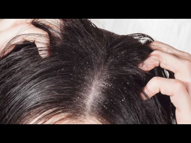 remedios-caseros-para-la-caspa-del-cabello-en-mujeres