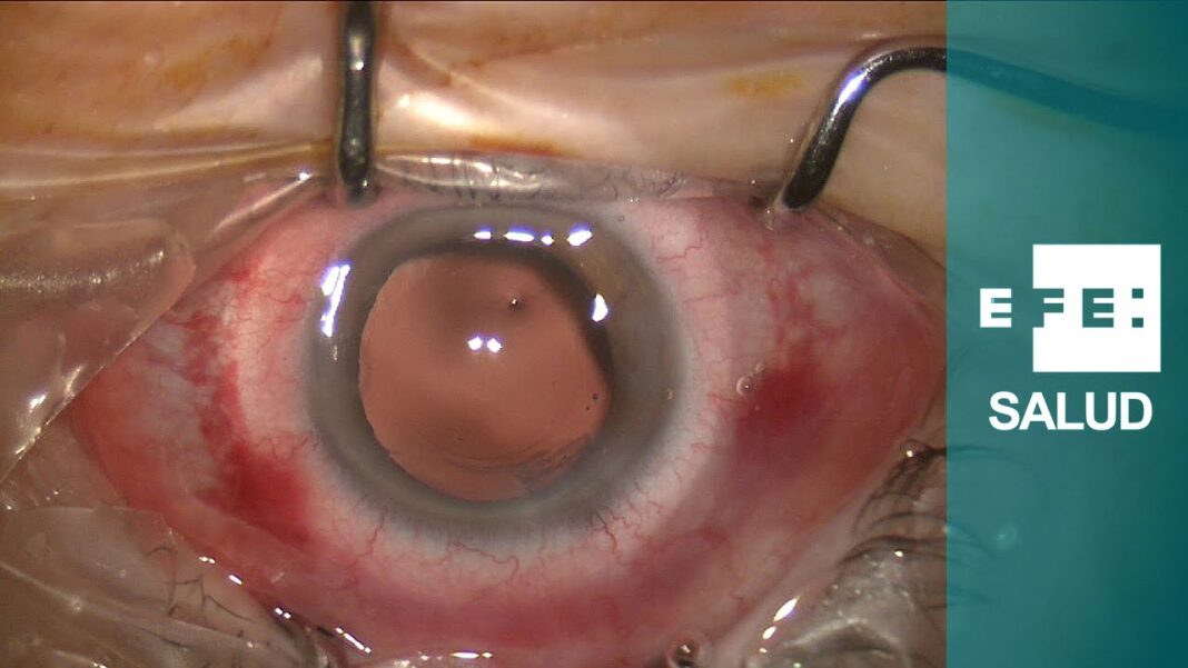 remedios-caseros-para-la-pupila-dilatada