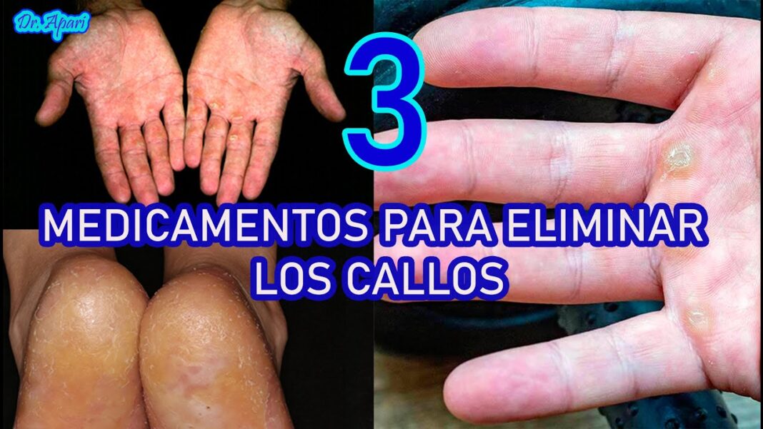 remedios-caseros-para-los-callos-en-las-manos