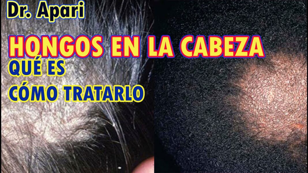 tina-cuero-cabelludo-remedios-caseros